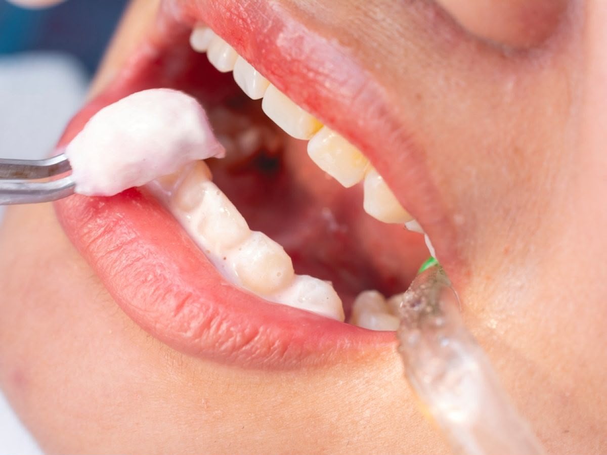 Fluoride and Prevention Programs